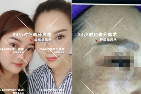 24小时色斑分离术，祛斑效果都写在脸上了