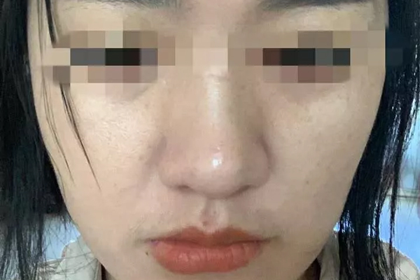 没有祛不掉的斑，只有没有找对的人--轻美素颜专业祛斑