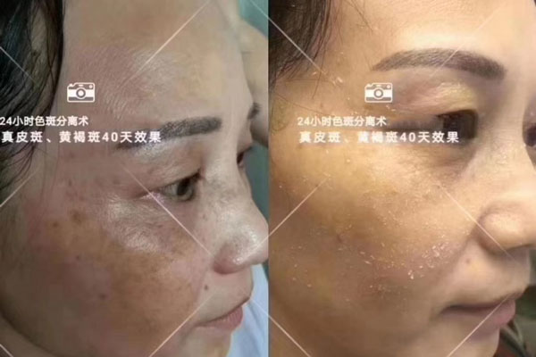 真皮斑-黄褐斑一次效果展示