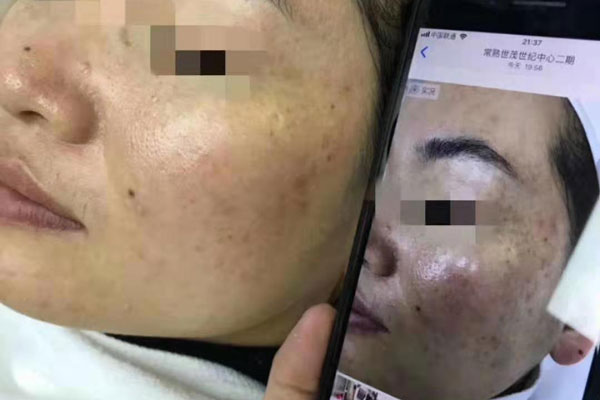 黄褐斑40分钟效果新鲜出炉