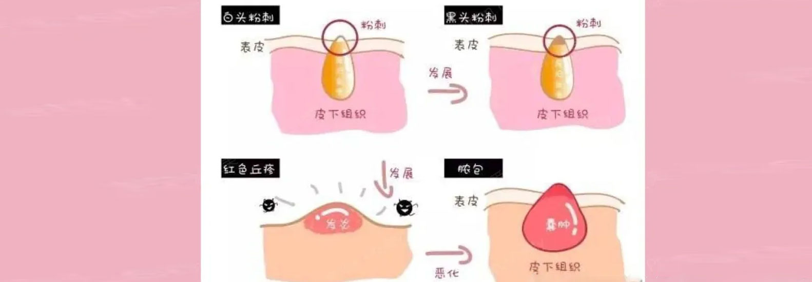 终结黑头最有效的办法是什么？就看这篇良心指南