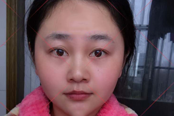 不要让色斑遮住你倾世之容颜