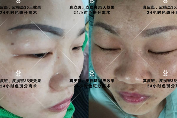 24小时祛斑-真皮斑、皮损斑35天效果